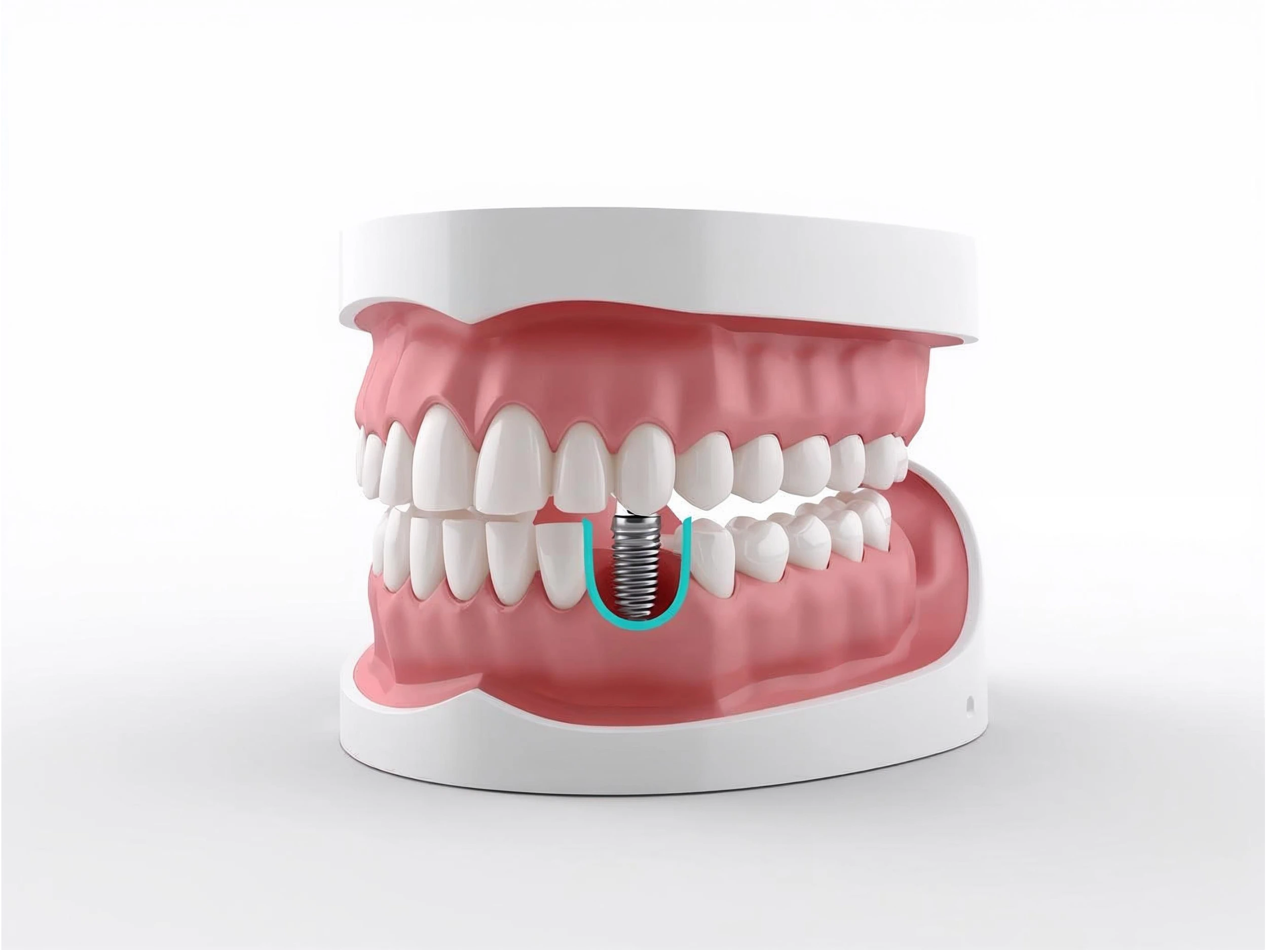 Tekirdağ implant tedavisi - Dt. Ahmet Fatih Ergün